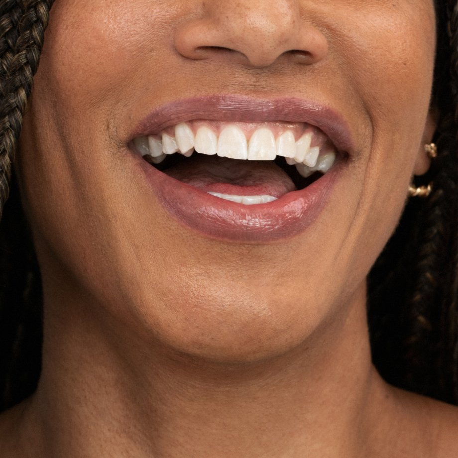 A RHA Redensity® patient using a straw to demonstrate the filler.