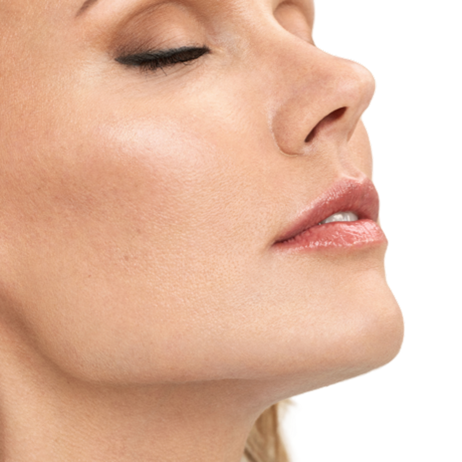 A patient with RHA 4 to show natural volume of the facial filler.